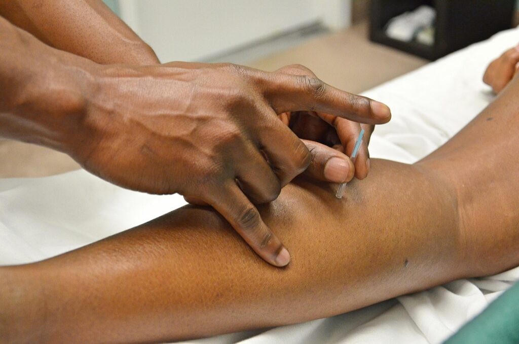 Physiotherapist performing acupuncture